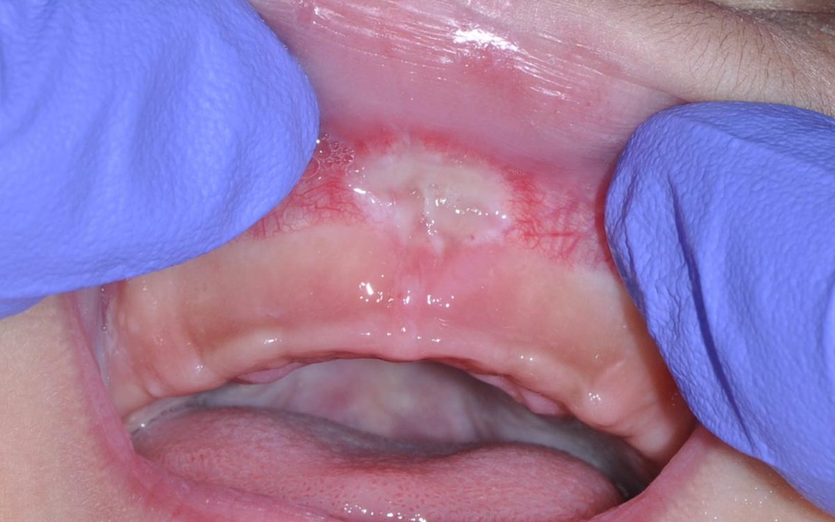 Tongue/ Lip Tie Corrections Johnson Family Dentistry Dentist in